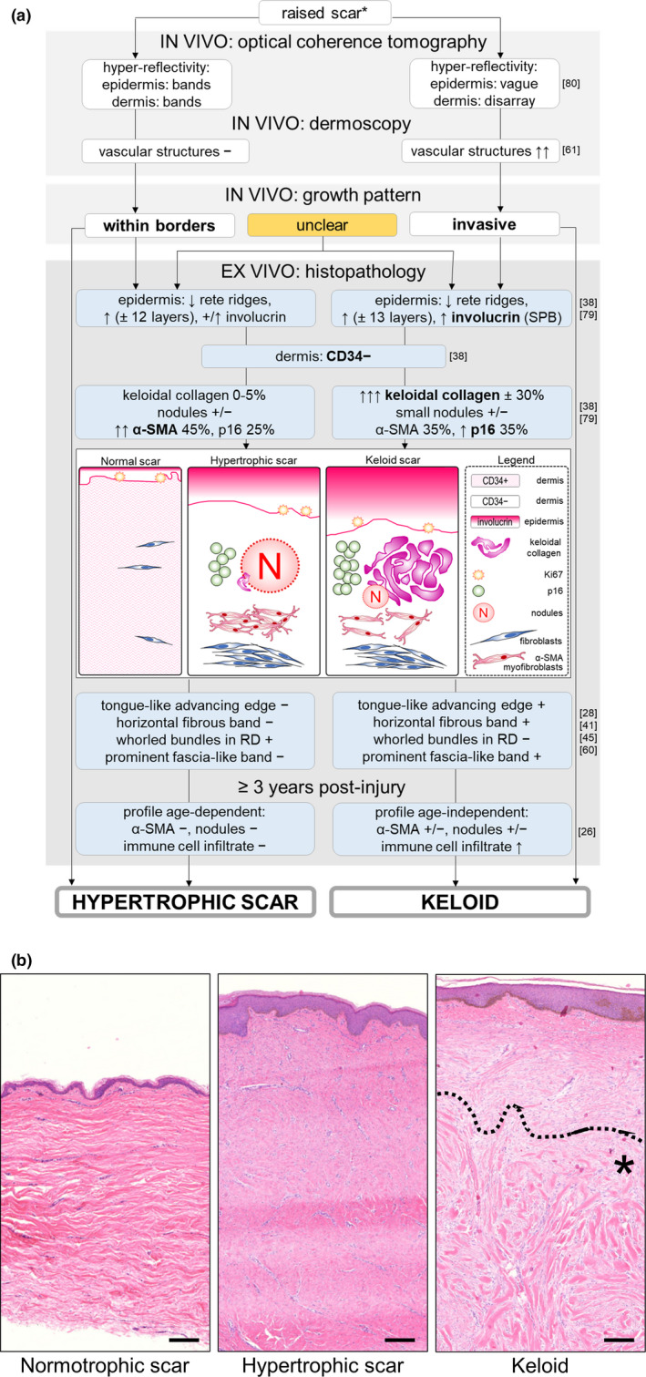 Hypertrophic scars and keloids: Overview of the evidence and practical ...