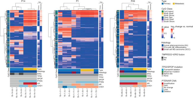 Figure 2. Intrapatient variation between selected primary and metastatic samples. The samples from each patient were clustered using the 1% most variably methylated CpG sites from the Illumina EPIC array (8,038 sites). Heatmap shows β values for primary and metastatic samples. Class of CpG (in relation to CpG island) is shown in blue/green heatmap on the left. Average log2 fold change of the primary tumors and metastases compared with normal prostate tissue are shown on the right. Sample type (primary or metastatic), histology, and genetic alterations from whole-exome sequencing are annotated below.