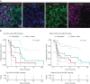 Figure 1. Low tsMHC-I expression is associated with a lack of benefit to immunotherapy-treated metastatic (m) TNBC. A, mIF for HLA-A/B/C (MHC-I) and panCK (merged and single channel example shown) was performed on 84 baseline/pretherapy archived biopsy samples collected from patients with metastatic TNBC in a randomized phase II clinical trial of carboplatin ± atezolizumab. Scale bar, 20 µm. B, Progression-free survival was compared using the log-rank test between carboplatin ± atezolizumab metastatic TNBC patients with the highest tsMHC-I expression (top 33%) and those with the lowest tsMHC-I expression (bottom 33%). Confidence intervals for each arm are represented as red or green dotted lines and median survival for each arm are plotted as black dotted line.