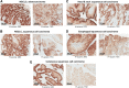 Figure 1. Expression of integrin beta-6 protein in cancer. Integrin beta-6 protein expression was confirmed by IHC using FFPE-sections from the indications shown. Representative H-scores of membranous staining are indicated below each image. H-score distributions are shown in Supplementary Fig. S3.