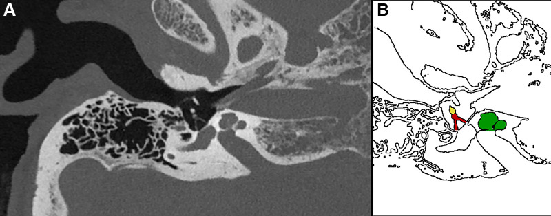 (A) Ultrahigh-resolution photon-counting CT image (Siemens Healthineers scanner) and (B) corresponding illustration of the temporal bone in a 53-year-old woman being examined for loss of hearing. The image shows the stapes (red shading in B) and its anterior and posterior arches in high anatomic detail as well as the lenticular process of the incus (yellow shading in B) and the incudostapedial joint (interface between the red and yellow structures in B). Several inner ear structures, such as the cochlea (green shading in B), are also visualized.