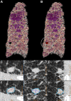 Example ultrahigh-resolution photon-counting CT images (Philips Healthcare
scanner) of the lung show a centimetric solid nodule in a 58-year-old male
patient with unclassifiable idiopathic interstitial lung disease. (A) Volume
rendered image of lung parenchyma and (B) fusion volume rendered image between
lung parenchyma and high-contrast nodule and reticulation (white dotted circle).
(C–F) Quasi-isotropic multiplanar reconstruction images with 0.29
× 0.29 × 0.25-mm voxel size. (C–H) Multiplanar images show
a magnified view of the spiculated nodule (C–E) before and (F–H)
after automatic segmentation (IntelliSpace Portal, Philips) found in the lower
right lobe and measuring 238.2 mm3.