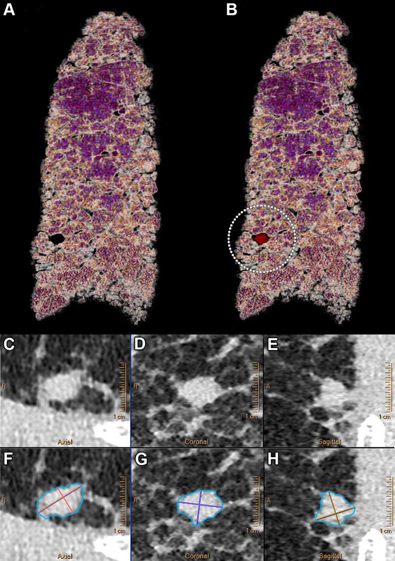 Example ultrahigh-resolution photon-counting CT images (Philips Healthcare scanner) of the lung show a centimetric solid nodule in a 58-year-old male patient with unclassifiable idiopathic interstitial lung disease. (A) Volume rendered image of lung parenchyma and (B) fusion volume rendered image between lung parenchyma and high-contrast nodule and reticulation (white dotted circle). (C–F) Quasi-isotropic multiplanar reconstruction images with 0.29 × 0.29 × 0.25-mm voxel size. (C–H) Multiplanar images show a magnified view of the spiculated nodule (C–E) before and (F–H) after automatic segmentation (IntelliSpace Portal, Philips) found in the lower right lobe and measuring 238.2 mm3.