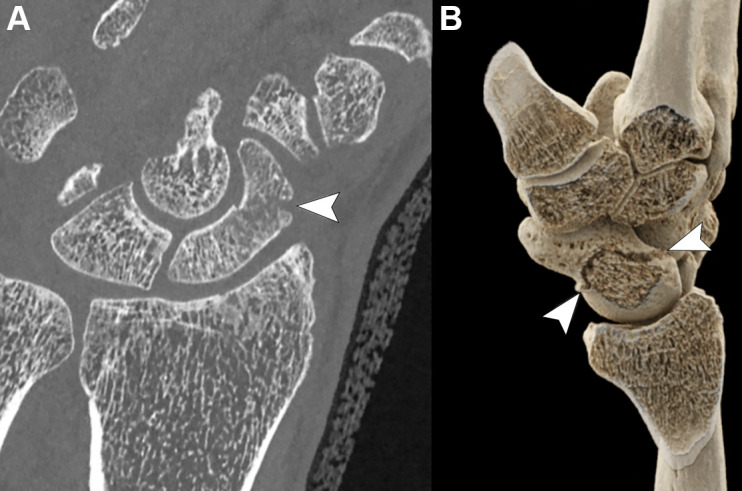 (A) Photon-counting CT coronal multiplanar image (Siemens Healthineers scanner) and (B) three-dimensional volumetric reconstruction using a cinematic rendering algorithm show a horizontal oblique fracture of the middle third of the scaphoid (arrowheads) in an otherwise healthy 47-year-old man.