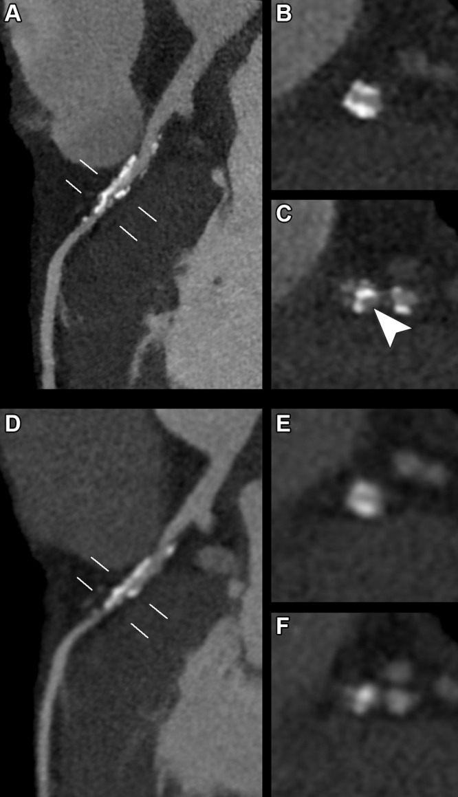 (A–C) Photon-counting CT (PCCT) (Philips Healthcare scanner) and (D–F) dual-energy CT (DECT) images show heavy calcifications of the left anterior descending coronary artery proximal and distal to the origin of the septal and diagonal branches in a 70-year-old woman who underwent coronary CT to investigate the cause of typical chest pain. PCCT images were reconstructed with a matrix of 1024 and voxels of 0.29 × 0.29 × 0.25 mm, whereas DECT images had a matrix of 512 with isotropic voxels of 0.67 mm. Curvilinear reconstructions of the (A, D) left main and left anterior descending coronary arteries show the two locations (white lines) where doubts arose regarding the presence of a significant stenosis. (B, E) The proximal view and (C, F) distal view cross-sectional images at these two locations show sharper, more defined and less bulky calcifications with (B, C) PCCT compared with (E, F) DECT. From a clinical point of view, this improved visualization of calcification confirmed the presence of (B, E) a significant proximal stenosis. Whereas with (E) DECT, the patency of the vessel was doubtful, the (B) PCCT image shows permeability of the vessel. More distally, after the origin of the branches, (C) PCCT allowed for diagnosis of stenosis due to the calcifications and afforded good visualization of the patent lumen (arrowhead). On the (F) DECT image, the distinction between calcifications and contrast material was not possible.