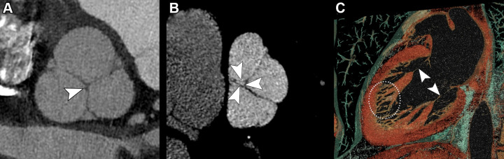 Examples of cardiac valves imaged with photon-counting CT (PCCT) (Philips Healthcare scanner). (A) PCCT image shows an aortic valve in a multiplanar reconstruction with a well-depicted nodule of Arantius of the noncoronary cusp (arrowhead) in a 45-year-old man with a history of myocardial infarction in the territory of the left anterior descending artery. (B) PCCT image depicts a pulmonary valve showing a small orifice of regurgitation (arrowheads) in the same patient whose aortic valve is imaged in panel A. (C) A volume rendering shows the mitral valve apparatus, including the chordae (arrowheads) and the trabeculae of the left ventricle (white dotted outline), in a 47-year-old woman with a history of acute coronary artery disease.