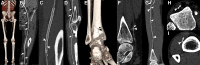(A–F) Abdominal aorta peripheral runoff photon-counting CT
(PCCT) scan (Siemens Healthineers) in a 56-year-old man with intermittent
claudication with a stent in the left superficial femoral artery and diffuse
atherosclerosis in both legs. The entire scan range was reconstructed as a
single image stack by using a field of view large enough to include the
entire patient at the abdominal region. (A) Three-dimensional cinematic
rendering reconstructions from the entire scan range (posterior view).
Curved multiplanar reformats of the (B, D) upper and lower left leg and (C)
zoomed-in image of the stent region. Notice the diffuse atherosclerosis
(arrows in B and D) and the in-stent intimal hyperplasia (arrowheads in C).
(E) Three-dimensional cinematic rendering reconstruction of the region of
the left ankle and (F) multiplanar reformat. On E and F, very small vessel
diameter can be observed (arrowheads) even though it is next to the
calcification (arrows). (G–I) Abdominal aorta peripheral runoff PCCT
scan in a 68-year-old patient with intermittent claudication, most severe on
the left side. (G) Curved multiplanar reformation of the left anterior
tibial artery with extensive calcifications (arrows) and (H, I) axial images
at the level of the ankle and distal left lower leg. Notice how the lumen
can be accurately assessed (G–I, arrowheads) despite the
calcifications (G–I, arrows).