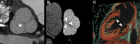 Examples of cardiac valves imaged with photon-counting CT (PCCT)
(Philips Healthcare scanner). (A) PCCT image shows an aortic valve in a
multiplanar reconstruction with a well-depicted nodule of Arantius of the
noncoronary cusp (arrowhead) in a 45-year-old man with a history of
myocardial infarction in the territory of the left anterior descending
artery. (B) PCCT image depicts a pulmonary valve showing a small orifice of
regurgitation (arrowheads) in the same patient whose aortic valve is imaged
in panel A. (C) A volume rendering shows the mitral valve apparatus,
including the chordae (arrowheads) and the trabeculae of the left ventricle
(white dotted outline), in a 47-year-old woman with a history of acute
coronary artery disease.