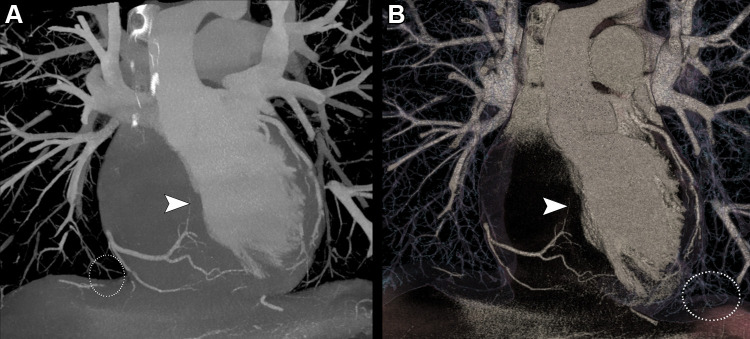 (A) Maximum intensity projection and (B) volume rendered reconstructions of a coronary photon-counting CT angiography examination (performed with a Philips Healthcare scanner) in a 38-year-old man with history of myocardial infarction in the territory of the left anterior descending artery. Both images show distal branches of the right coronary artery, including the artery passing in the interatrial septum to reach the atrioventricular node (arrowheads). The distal pulmonary vessels are also clearly visible on these images (white dotted outlines). Reconstructions were performed with a 0.29 × 0.29 × 0.25-mm voxel size with a 1024 matrix size.