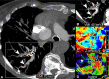Example lung photon-counting CT angiography images (Philips Healthcare
scanner) with a multiparametric imaging analysis of the lung anatomy and its
function show pulmonary embolism and its impact on the lung perfusion in a
41-year-old woman with pulmonary hypertension. (A) An axial 5-mm-width maximum
intensity projection virtual monoenergetic image (VMI) at 70 keV that
substitutes a 120-kVp conventional image due to similar mean energy of its
spectrum. Multiple filling defects are seen in the right lower lobe
(arrowheads). Also visible are the dilated distal pulmonary vessels (arrow)
suggesting pre-existing pulmonary hypertension. (B) An axial 5-mm-width maximum
intensity projection VMI at 40 keV that simulates the attenuation of a tissue at
low energy (ie, 40 keV), consequently enabling an increase in CT attenuation of
iodine due to an energy being close to its K-edge (33.2 keV). This effect
enables a greater discrimination of the emboli (arrowheads) responsible for
subsegmental partial and complete filling defects. (C) An axial 5-mm-width
Z-effective image that measures the integrated atomic number of the tissue
within a voxel. The contrast generated from the image is color-coded (in red are
lower Z-effective values and in blue, higher Z-effective values) and enables the
visualization of a perfusion defect downstream from the embolus completely
occluding the laterobasal subsegment of the right lower lobe (★). (D) An
axial 5-mm-width iodine map, a validated surrogate marker of lung perfusion that
contributes to the functional assessment of vascular lung diseases. The contrast
generated from the image is color-coded (black means no iodine, and red, a high
iodine concentration) and enables visualization of an embolic-type perfusion
defect downstream from the complete filling defect in the laterobasal subsegment
of the right lower lobe (★). On the contrary, in the posterobasal
subsegment, where a partial filling defect is seen in a subsegmental branch of
the right lower pulmonary artery, the perfusion is preserved (white dotted
circle).