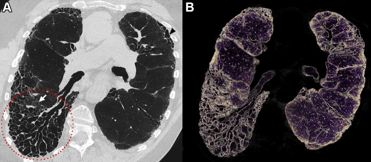 Example lung ultrahigh-resolution photon-counting CT images (Philips Healthcare scanner) show a typical usual interstitial pneumonia in a 73-year-old male patient. (A) Coronal oblique image with 0.29 × 0.29 × 0.25-mm voxel size shows subpleural predominant reticular abnormality with distal traction bronchiectasis and an area of honeycombing occurring in single or multiple layers (arrowhead). An important area of distal bronchiectasis and bronchiolectasis is seen in the right lower lobe with a clear visualization of the bronchial lumen from the center to the subpleural space (red dotted circle). An area of ground-glass opacity (arrow) is shown to present reticulations and traction bronchiectasis, indicating a fibrosis pattern. (B) A 3-mm-width volume rendered image with clear visualization of the traction bronchiectasis, honeycombing, and architectural distortion of the lungs.