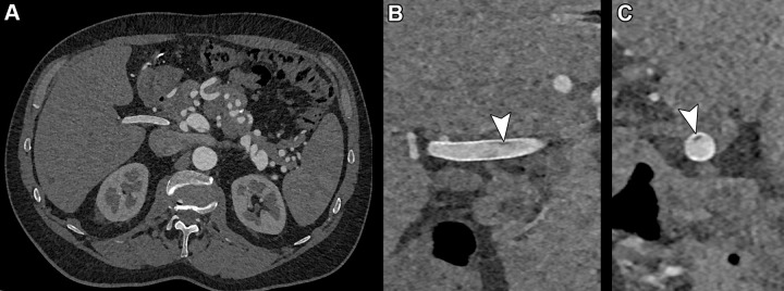 Photon-counting CT images reconstructed at 0.4 mm using a Bv48 kernel (Siemens Healthineers) in a 55-year-old man with SMAD3 variation and osteoarthritis syndrome with previous aneurysm of the hepatic artery that had been treated with stent placement. (A) Complete axial field of view image at the level of the hepatic artery stent with detailed image quality of the vascular structures. (B) Zoomed-in coronal and (C) sagittal images of the stent reveal a very small hypointense area inside the stent (arrowheads) compatible with a small area of thrombus formation.