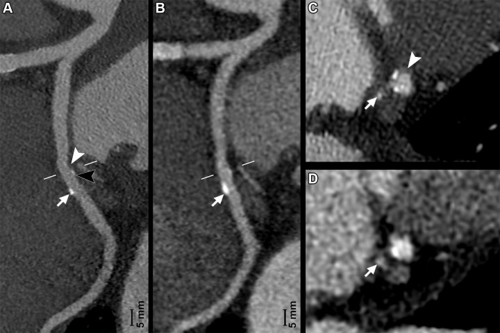 (A, C) Photon-counting CT (PCCT) (Philips Healthcare scanner) and (B, D) dual-energy CT (DECT) images show minimal atherosclerotic lesions of a circumflex coronary artery in a 66-year-old man with known coronary artery disease. A and B show curved multiplanar reconstructions of the artery, while C and D show the cross-axial planes (white lines in A and B). Curved multiplanar reconstruction images reveal the presence of two lesions of this artery. The first lesion was small but clearly depicted by PCCT and presented a soft component (A, white arrowhead) and a calcified component (A, black arrowhead) invisible and barely visible, respectively, on the (B) DECT image. The second lesion was bigger, and the calcified component (arrows in A and B) was visible at both PCCT and DECT. Notice how with DECT, this calcification (arrow in B) presents fuzzy borders due to blooming artifacts. On (C, D) cross-axial images, the more proximal lesion is localized at the level of the origin of a tiny branch (arrows), the artery for the sinoatrial node. PCCT allowed for better definition and characterization of this plaque, as it showed two spotty calcifications and the soft component (C, arrowhead), all barely visible with (D) DECT. PCCT images were reconstructed with a matrix of 1024 and voxels of 0.29 × 0.29 × 0.25 mm, whereas DECT images had a matrix of 512 with isotropic voxels of 0.67 mm.