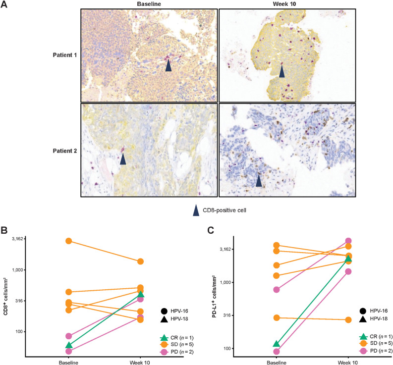 Figure 3. Intratumoral immunomodulation: CD8 IHC images from tumors of 2 patients showing increased numbers of CD8+ T cells at week 10 versus baseline—CD8+ T cells are stained purple and cytokeratin is stained yellow in the top two and the bottom left images, and CD8+ T cells are stained brown in the bottom right image (A); change in tumoral CD8+ T-cell count from baseline to week 10 (n = 8; B); and change in tumoral PD-L1+ cell count from baseline to week 10 (n = 8) by HPV status on IHC analysis of individual patients with paired tumor biopsies, with lines color coded according to best response (C).