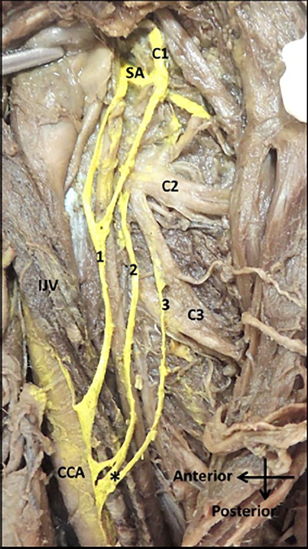 Figure 1: Triple form of the ansa cervicalis with variant inferior root fibres in the left carotid triangle