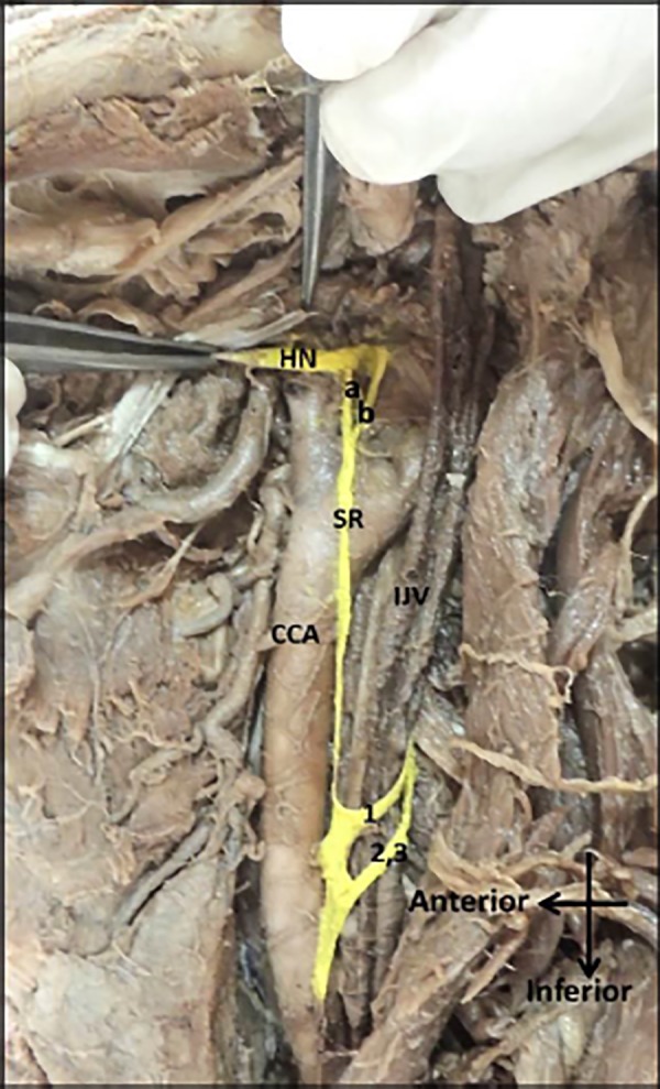 Figure 2: Bifurcated superior root of the ansa cervicalis in the left carotid triangle