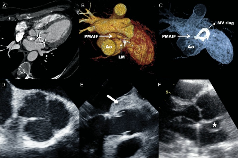 Pseudoaneurysm of the mitral-aortic intervalvular fibrosa as a ...