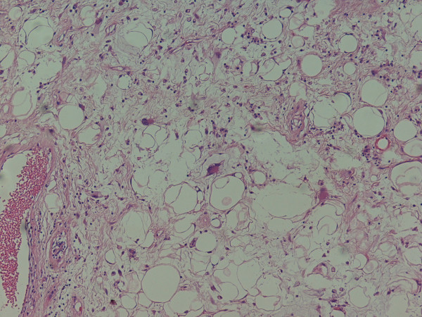 Primary Mediastinal Liposarcoma: A Case Report - Pmc