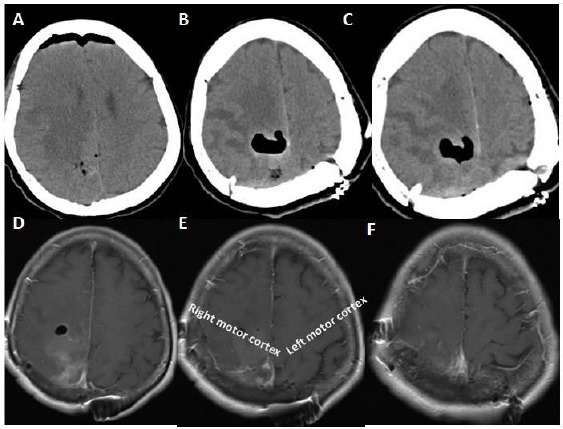 Correlation Of The Ct Compatible Stereotaxic Craniotomy With Mri Scans 