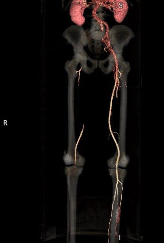 Acute Limb Ischemia Secondary To External Iliac And Common Femoral