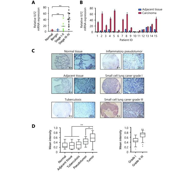 (A) ILF2 levels were analyzed by qRT-PCR in cDNA from 15 SCLC patient samples representing all disease stages and grades, 5 lung tissues with benign disease and 5 normal lung samples. (B) ILF2 levels were analyzed by qRT-PCR in 15 SCLC samples with paired adjacent normal lung tissues. (C and D) Immunohistochemical staining of tissue arrays. The mean staining intensity was calculated using Image-Pro Plus software. Representative IHC images showing ILF2 and E2F1 expression in SCLC tissue microarray (C). *, <italic>P</italic> &lt; 0.05, * *, <italic>P</italic> &lt; 0.01.