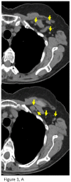 69-year-old female with a history of lung adenocarcinoma and recent left
arm COVID-19 vaccination three days prior (first dose). (A) Axial images from
chest CT show left axillary and subpectoral lymphadenopathy (arrows) (B)
Comparison chest CT images from one-year prior show normal left axillary lymph
nodes.