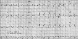 ECG 2