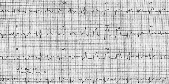 ECG 2