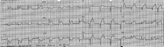 ECG 1