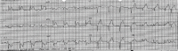 ECG 1