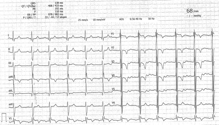 Patient after correction Taussig‐Bing anomaly with severe neo‐aortic ...