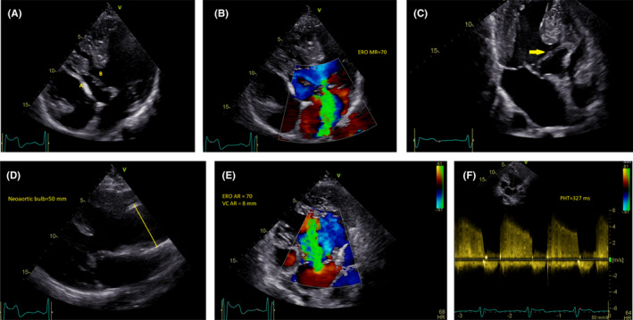 Patient after correction Taussig‐Bing anomaly with severe neo‐aortic ...