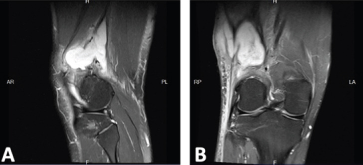 Challenges in the Diagnosis of Brodie’s Abscess in Subacute ...