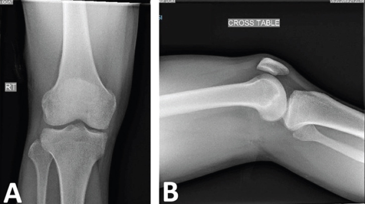 Challenges in the Diagnosis of Brodie’s Abscess in Subacute ...