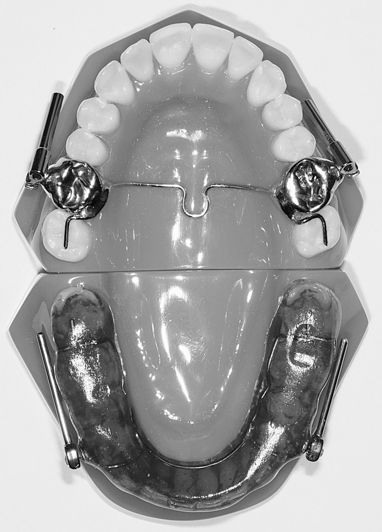 Figure 1. Herbst appliance with stainless steel crowns (Ormco) on the maxillary first molars and removable mandibular acrylic splint.