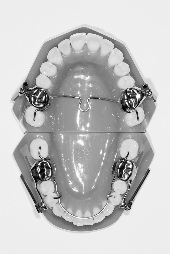 Figure 2. Herbst appliance with four stainless steel crowns (Ormco) on the first upper and lower molars.