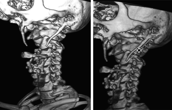 Stylalgia and Styloidectomy: A Review - PMC