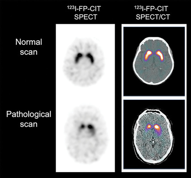 Dopaminergic imaging with SPECT. Representative transaxial iodine 123–2β-carbomethoxy-3β-(4-iodophenyl)-N-(3-fluoropropyl)-nortropane (123I-FP-CIT) SPECT (left column) and 123I-FP-CIT SPECT/CT (right column) images show normal binding of tracer (top row) in healthy control patient with symmetrical and homogeneous tracer retention in striatum. Bottom row shows pathologic 123I-FP-CIT binding, with marked and asymmetric decrease of tracer binding in striatum. Images reflect typical progression of decreased 123I-FP-CIT binding reflecting asymmetric loss of nigrostriatal terminals in striatum, usually starting in tail of putamen progressing rostrally through anterior putamen and into head of caudate nucleus.