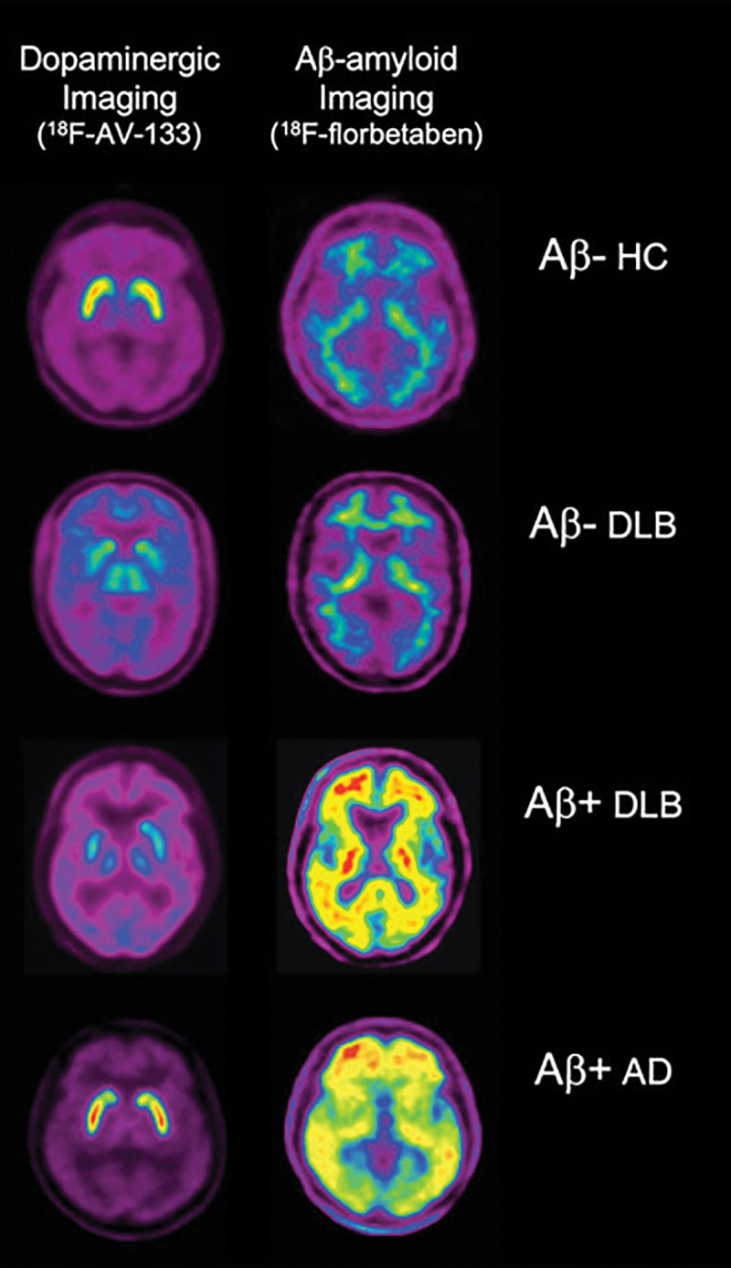 Comparison of vesicular monoamine transporter type 2 (VMAT2) imaging with fluorine 18 (18F) AV-133 and Aβ imaging with 18F florbetaben. Representative coregistered transaxial 18F AV-133 and florbetaben PET images in an older healthy control (HC) patient show low Aβ burden and normal striatal VMAT2 densities. PET images in patient with Alzheimer disease (AD) show high Aβ burden and normal striatal VMAT2 densities. For the two patients with dementia with Lewy bodies (DLB), images in patient with DLB with low Aβ burden are indistinguishable from those in the HC patient, and images in patient with DLB with high Aβ burden are indistinguishable from those in the patient with AD. In contrast to Aβ burden images, both patients show markedly reduced VMAT2 densities in striatum, clearly differentiating them from the healthy control patient and the patient with AD. Moreover, PET images provide higher resolution and sensitivity, making separation between caudate and putaminal binding by internal capsule better visible.