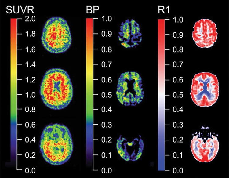 Quantitative versus semiquantitative imaging. Representative standard uptake value ratio (SUVR) (left column), binding potential (BP) (center column), and relative perfusion measure (R1) (right column) carbon 11 Pittsburgh compound B images. In contrast with semiquantitative SUVR from a 20–30–minute static acquisition, quantitative parametric BP images derived from dynamic acquisition not only yield much higher contrast images than SUVR, facilitating visual inspection by eliminating nonspecific binding, but dynamic acquisition also allows for quantification of regional relative perfusion measures that add valuable information for assessment of a patient or therapeutic trial participant.