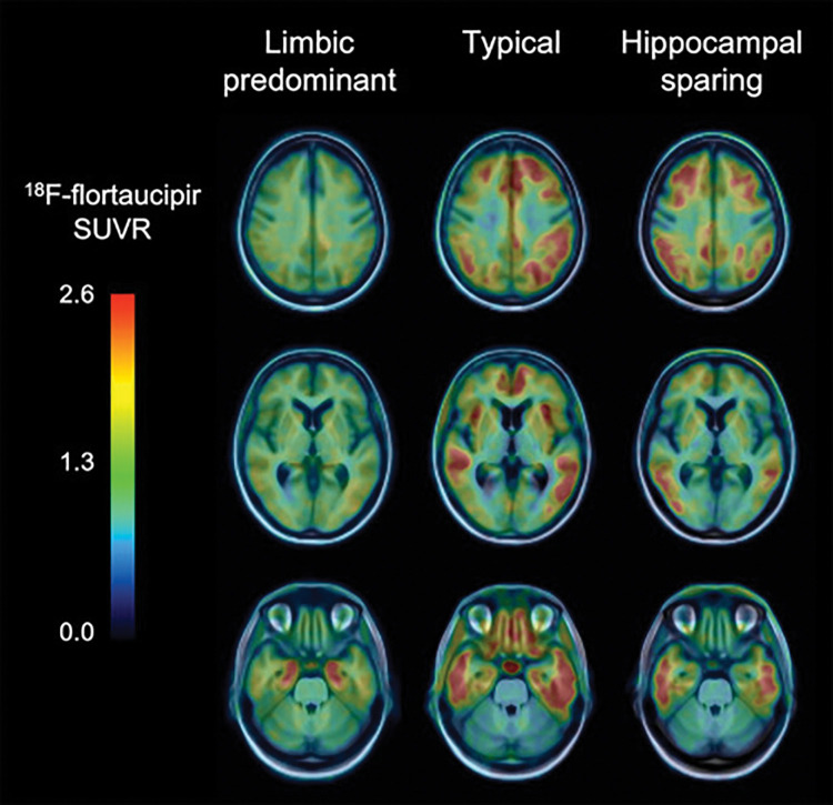 Tau imaging helps identify pathologic subtypes in Alzheimer disease (AD). Fluorine 18 (18F) flortaucipir PET images in three patients with AD show three different pathologic subtypes of AD: limbic predominant (left column) with tracer retention mostly restricted to mesial temporal lobes, typical presentation (center column) with widespread retention in both mesial temporal lobes and neocortical areas, and hippocampal sparing subtype (right column) where tracer retention is predominantly in neocortex. SUVR = standardized uptake value ratio.