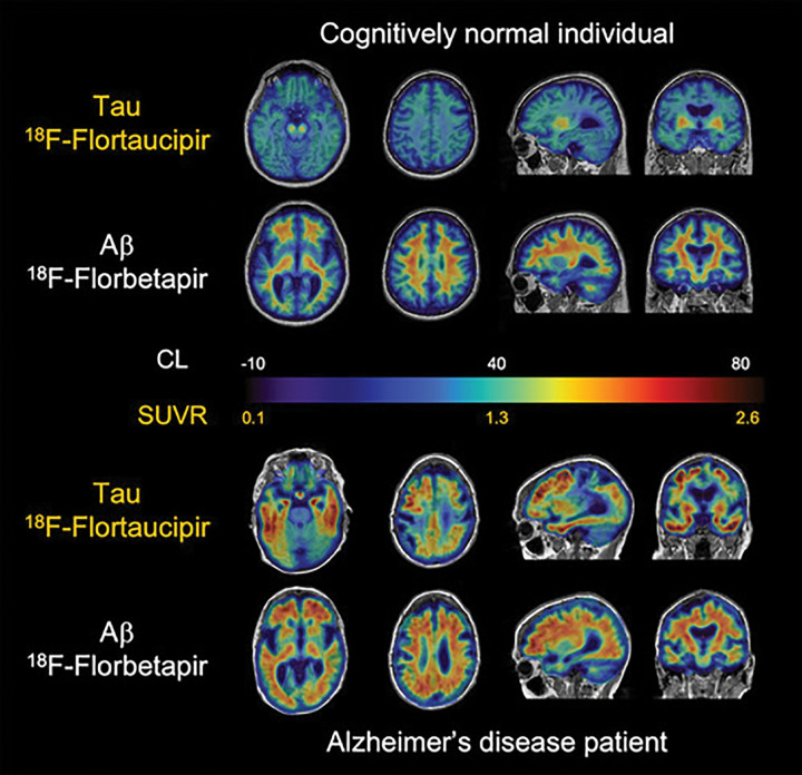 Aβ and tau imaging. Representative transaxial, sagittal, and coronal Aβ-amyloid fluorine 18 (18F) florbetapir and tau (18F-flortaucipir) PET images overlayed on MRI scans in individual with normal cognition (top two rows) and patient with Alzheimer disease (AD) (bottom two rows). Individual with normal cognition has typical pattern of flortaucipir off-target binding in basal ganglia and choroid plexus but minimal on-target binding related to tau accumulation in medial temporal lobe or throughout cortex. Florbetapir PET images are representative of typical “negative” Aβ-amyloid scan, showing typical widespread nonspecific retention throughout white matter, but this retention does not extend to cortex. Although patient with AD has similar flortaucipir off-target binding, there is extensive and marked on-target tracer retention in medial and lateral temporal lobes, extending to frontal and parietal lobes, despite considerable atrophy that is apparent from structural MRI. Florbetapir PET scans show Aβ-amyloid accumulation distributed relatively uniformly throughout neocortex. CL = Centiloids, SUVR = standardized uptake value ratio.