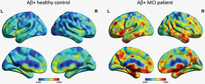 Imaging of astrocytosis. Carbon 11-deuterium-l-deprenyl PET surface projection images of astrocyte activation in healthy control patient and patient with mild cognitive impairment (MCI). Both patients are Aβ-amyloid positive. Color scale indicates modified reference (cerebellar gray matter) Paltak slope values (Nordberg Translational Molecular Imaging Laboratory, Karolinska Institutet, Sweden).