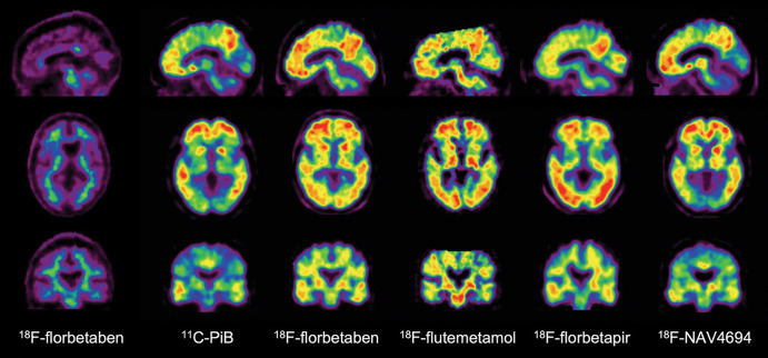 Aβ imaging. Representative sagittal, transaxial, and coronal PET images in control patient without cognitive impairment (left column) and five different patients with Alzheimer disease (AD). At visual inspection, fluorine 18 (18F) florbetaben scan in control patient without cognitive impairment shows nonspecific tracer retention in white matter. All patients with AD have present high Aβ burdens, reflected in marked radiotracer retention in cortical and subcortical gray matter areas. Cortical tracer retention is higher in patients with AD compared with the control patient, leading to blurring of normally visible gray matter and white matter interface. Tracer retention in AD is particularly higher in frontal, cingulate, precuneus, striatum, parietal, and lateral temporal cortices, whereas occipital, sensorimotor, and mesial temporal lobes are much less affected. All of these tracers show a variable degree of nonspecific binding to white matter. Patients with AD were scanned with carbon 11 Pittsburgh compound B (11C-PiB), 18F-florbetaben, 18F-flutemetamol, 18F-florbetapir, and 18F-NAV-4696. 18F-flutemetamol (Vizamyl; GE Healthcare), 18F-florbetaben (Neuraceq; Life Molecular Imaging), and 18F-florbetapir (Amyvid; Avid Radiopharmaceuticals) have already been approved for clinical use by the U.S. Food and Drug Administration and European Medicines Agency. A binary visual readout approach ruling out Aβ-amyloid pathologic findings is recommended for the clinically approved tracers and is the one used for exclusion and/or inclusion in most anti-Aβ-amyloid therapeutic trials.