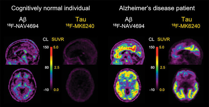 Aβ and tau imaging. Representative transaxial and sagittal Aβ-amyloid and tau PET images in older control patient with normal cognition (left) and in patient with Alzheimer disease (AD) (right) obtained with fluorine 18 (18F) NAV4694 for Aβ and 18F-MK6240 for tau, respectively. 18F-NAV4694 images show typical nonspecific tracer retention in white matter in control patient with normal cognition, whereas typical pattern of tracer retention in frontal, temporal, and posterior cingulate cortices is observed in patient with AD. 18F-MK6240 images show low tracer brain retention in control patient with normal cognition, whereas in patient with AD, a typical widespread pattern of high-contrast tracer retention, involving mesial temporal lobes and temporoparietal and posterior cingulate areas, and to a lesser extent in prefrontal cortex, is observed. Faint off-target retention in meninges is clearly observed in control patient with normal cognition. CL = Centiloids, SUVR = standardized uptake value ratio.