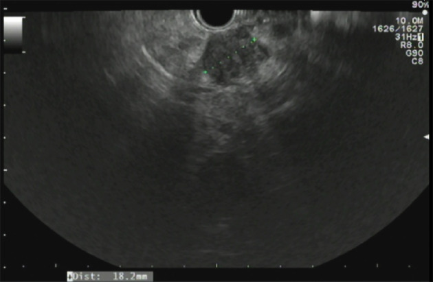 Pancreatitis and pancreatic cancer: A case of the chicken or the egg - PMC