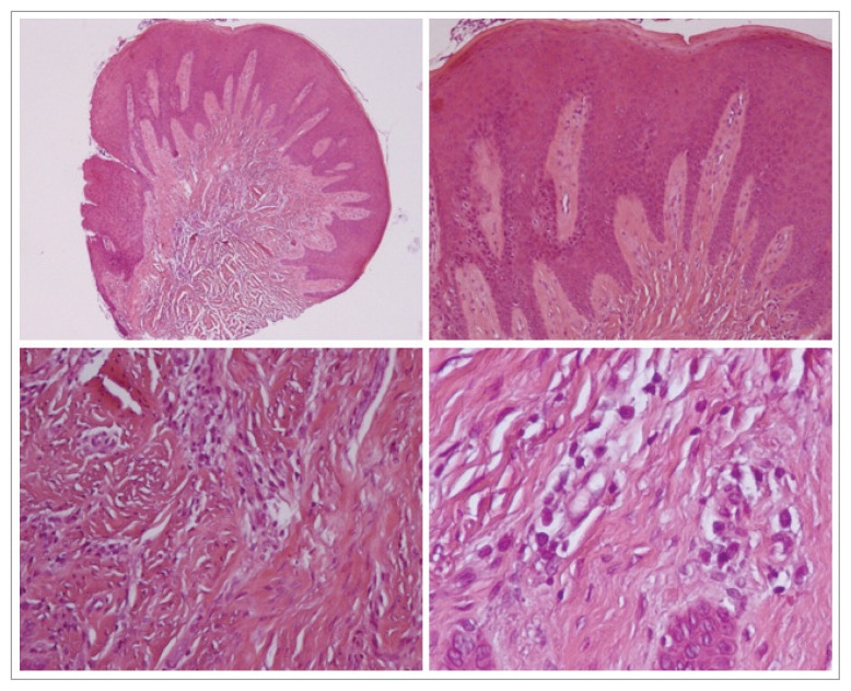 The gingival Stillman’s clefts: histopathology and cellular ...