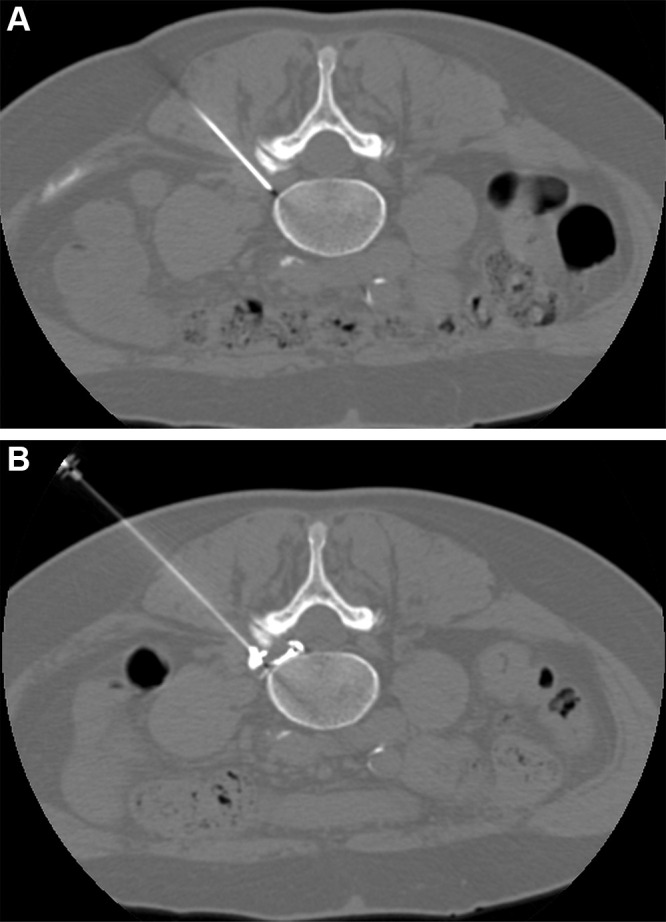 CT-guided pulsed radiofrequency (PRF) with transforaminal epidural steroid injection. A 62-year-old woman underwent PRF followed by transforaminal epidural steroid injection for sciatica due to left contained intraforaminal disk herniation at the L4-5 level. (A) A 22-gauge needle electrode with a 10-mm active tip was introduced and advanced using one 3-mm oblique axial unenhanced CT scan, which revealed that the needle tip was proximate to the target dorsal root ganglion with the lateral foraminal portal of entry. (B) Sensitive stimulation (50 Hz) PRF current with a threshold of no more than 0.2 V was used to confirm proper positioning by evoking tingling or electric pain in the dermatome that had to match the target dorsal root ganglion. Therapeutic PRF was then performed in one 10-minute session with E-dose functionality, maintaining temperature below the threshold for neural damage (42°C) and a constant voltage (45 V) (G4 RF Generator; Boston Scientific). Immediately after PRF administration, epidural spread of 0.3 mL of contrast material (350 mg of iodine per milliliter, Iomeron; Bracco) was confirmed using intermittent intraprocedural CT fluoroscopic imaging with no intravascular contrast material flow demonstration. A combination of steroid and anesthetic (1 mL lidocaine [ 20 mg/mL] and 2 mL dexamethasone [10 mg/mL]) was then injected without altering needle position to conclude the procedure.