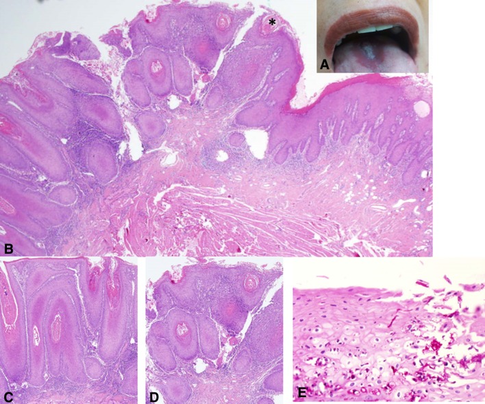 Tongue Lumps and Bumps: Histopathological Dilemmas and Clues for ...