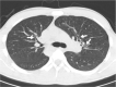 Cases illustrative of upgrading encountered in COVID-RADS. (a) An axial chest CT image of a 79-year-old female without COVID-19 shows consolidation, and centrilobular nodules without GGOs in the right lower lobe, representing typical appearances in bronchial pneumonia (dotted circle). There was bronchial wall thickening on other images (not shown). The consensus grading was CO-RADS 2, COVID-RADS 2A+1 (=2B), atypical appearance in the RSNA expert consensus statement, and non-COVID in the BSTI guidance statement. (b) An axial chest CT image of a 52-year-old male without COVID-19 shows segmental consolidation, reflecting typical appearance in lobar pneumonia (dotted circles). There was bilateral pleural effusion in this case (not shown in this figure), and the consensus grading was CO-RADS 2, COVID-RADS 2A+1 (=2B), atypical appearance in the RSNA expert consensus statement, and non-COVID in the BSTI guidance statement. (c) An axial chest CT image of a 23-year-old male without COVID-19 shows diffuse moderate bronchial wall thickening (arrows). The consensus grading was CO-RADS 1, COVID-RADS 2A, negative in the RSNA expert consensus statement, and non-COVID in the BSTI guidance statement. (d) An axial chest CT image of a 79-year-old male without COVID-19 shows bronchial wall thickening (arrow) but is otherwise normal. Bilateral gravity-dependent ground-glass opacities were considered non-pathological changes. The consensus grading was CO-RADS 2, COVID-RADS 2A, atypical appearance in the RSNA expert consensus statement, and non-COVID in the BSTI guidance statement. As illustrated in this case, COVID-RADS classifies bronchial thickening into higher grades than the other three sets of criteria.